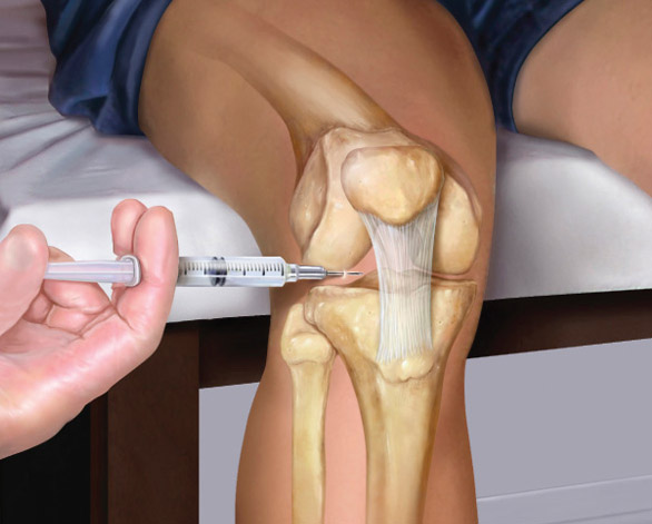 Joint Injections